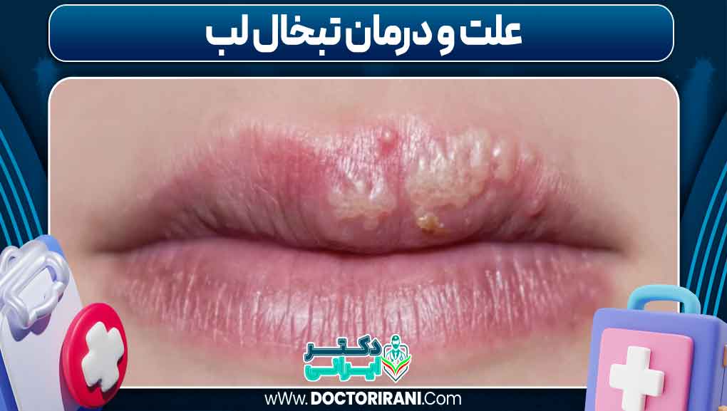 علت و درمان تبخال لب