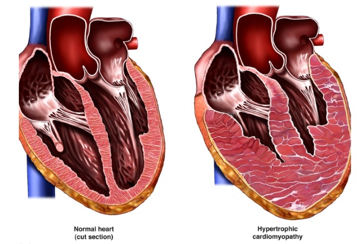 کاردیومیوپاتی ژنتیکی