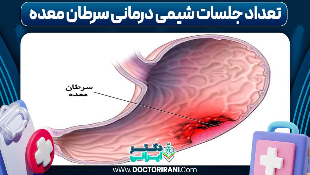 تعداد جلسات شیمی درمانی سرطان معده