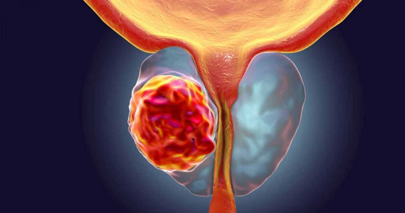 غربالگری سرطان پروستات