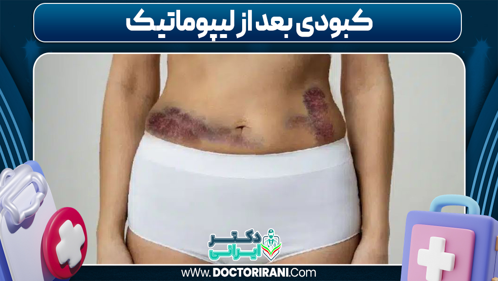 کبودی بعد از لیپوماتیک