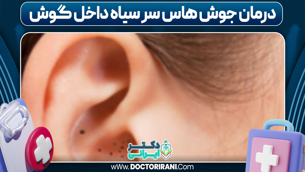 درمان جوش هاس سر سیاه داخل گوش