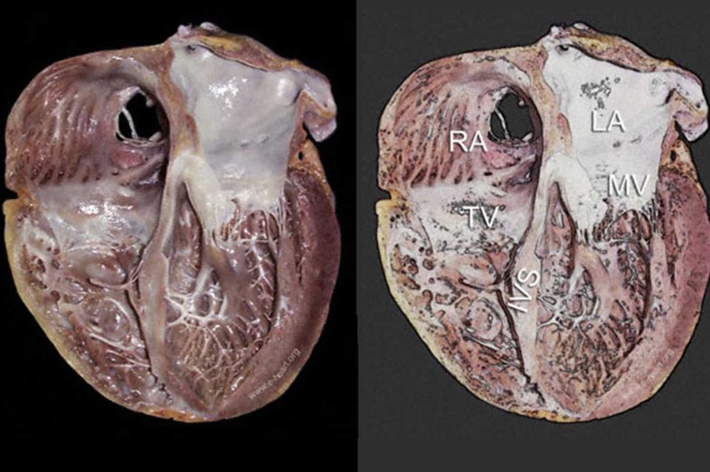 تفاوت کاردیومیوپاتی با نارسایی قلبی