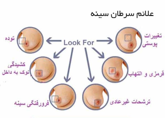 اندازه توده سرطان سینه 