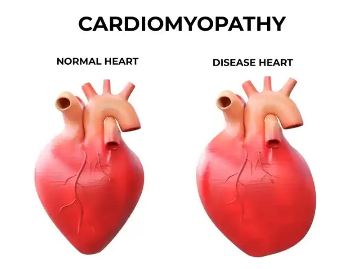 دارو برای کاردیومیوپاتی