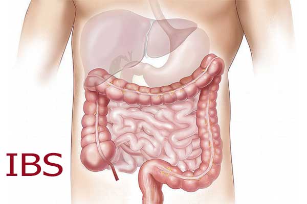 نشانه‌های IBS