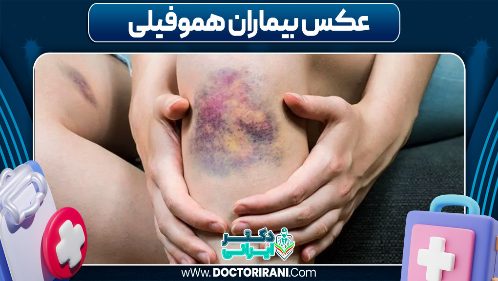 عکس بیماران هموفیلی