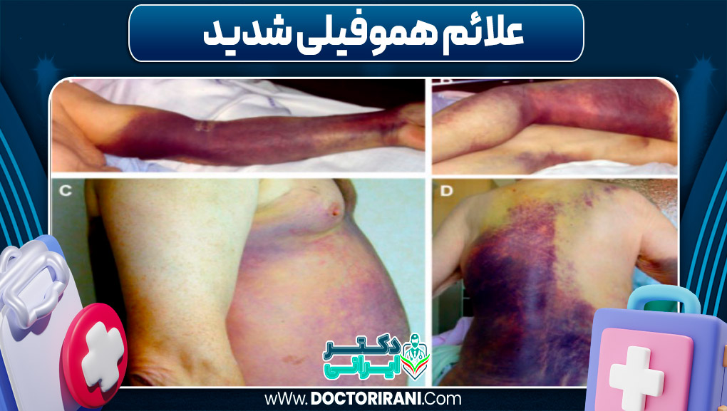 ‏علائم هموفیلی شدید