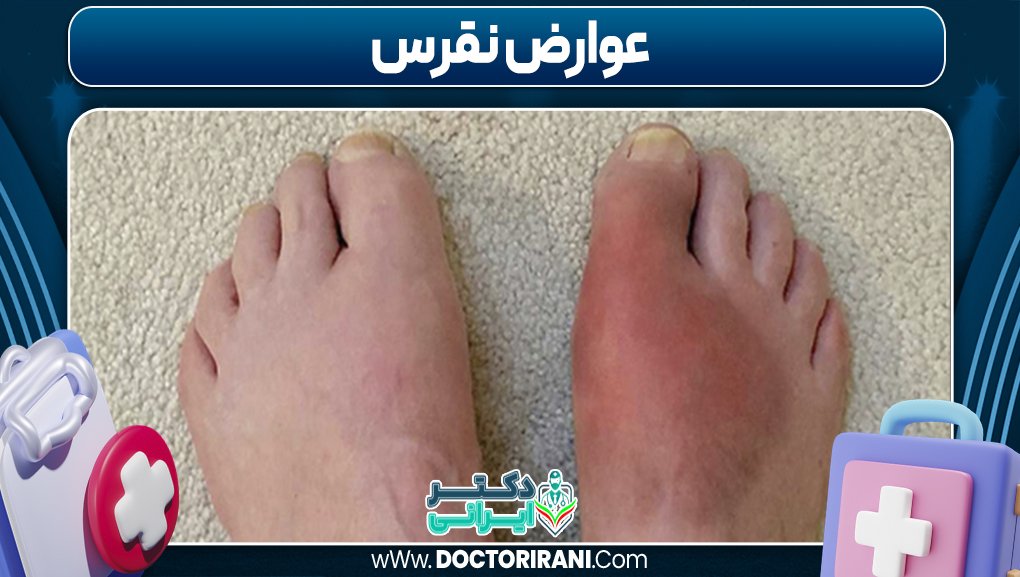 عوارض نقرس