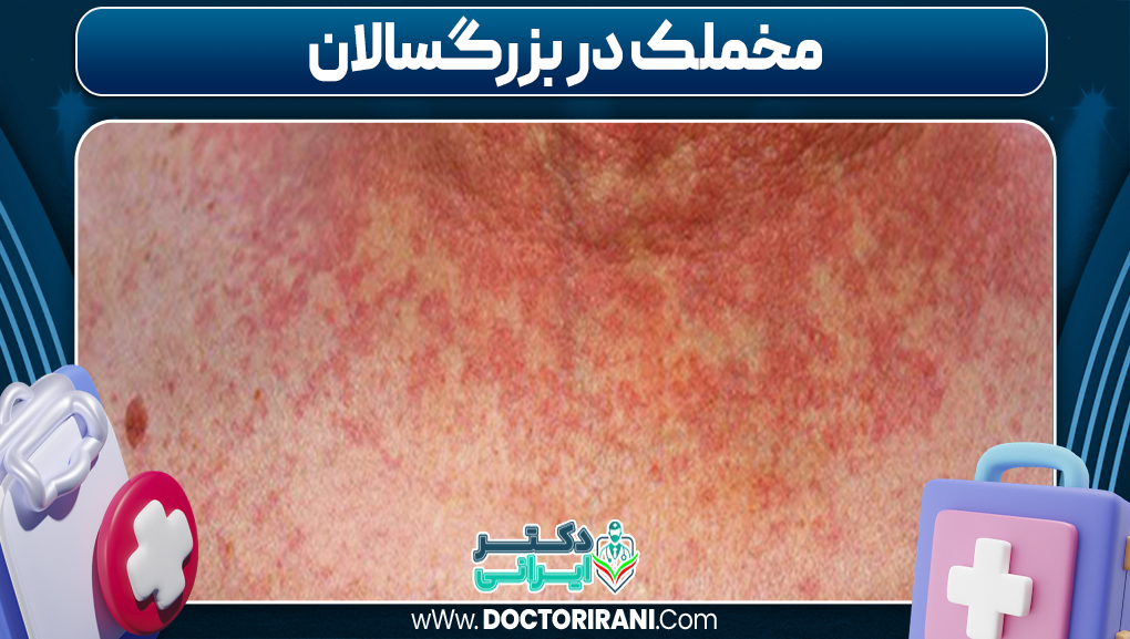 مخملک در بزرگسالان
