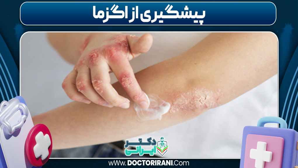 پیشگیری از اگزما