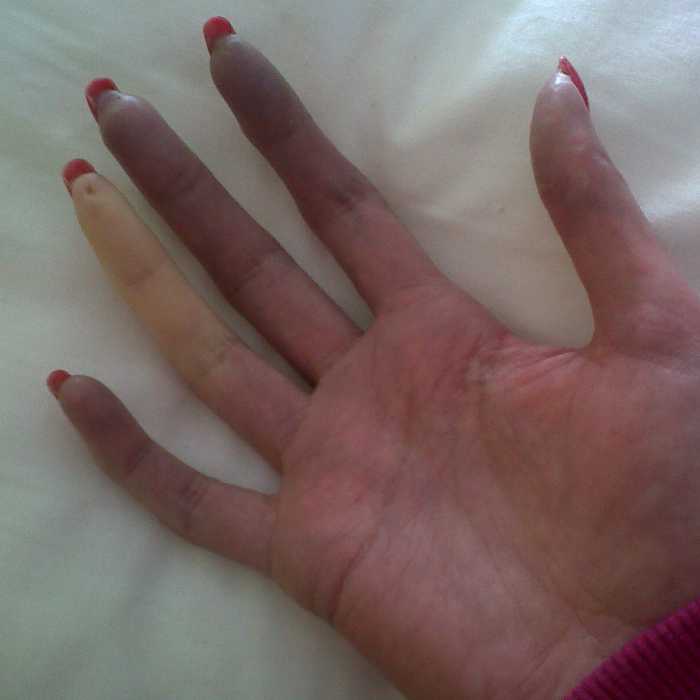 بیماری اسکلرودرمی عکس بیماری اسکلرودرمی عکس