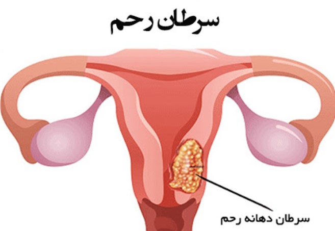 نشانه‌های سرطان رحم