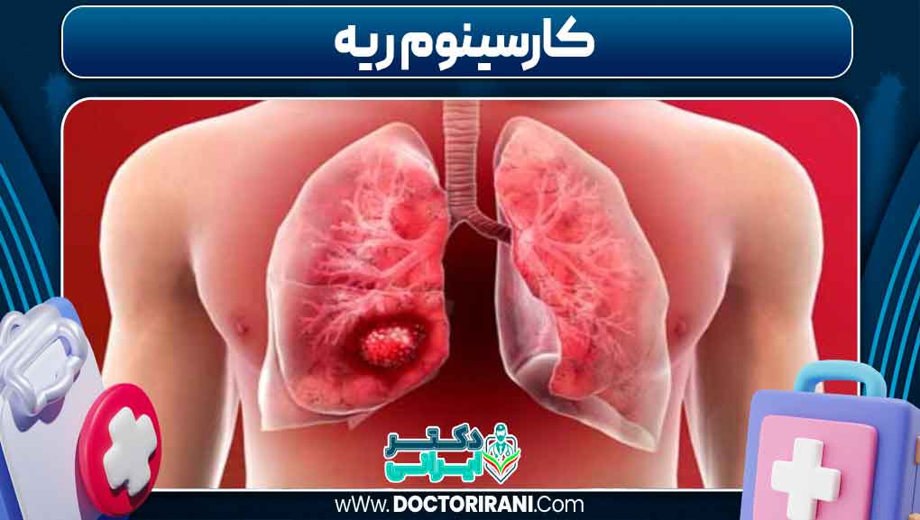 کارسینوم ریه