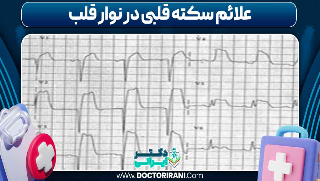علائم سکته قلبی در نوار قلب