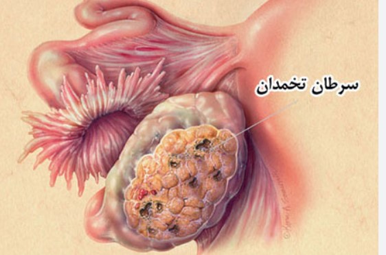 ژن‌های دخیل در سرطان تخمدان