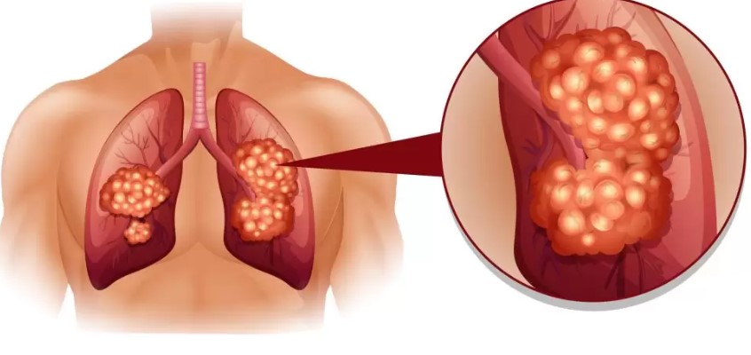 علائم متاستاز سرطان ریه به استخوان