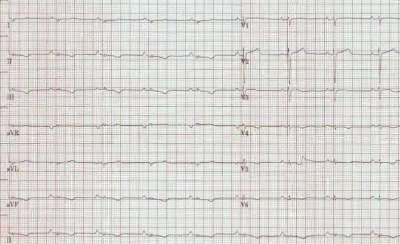نوار قلب در کودکان