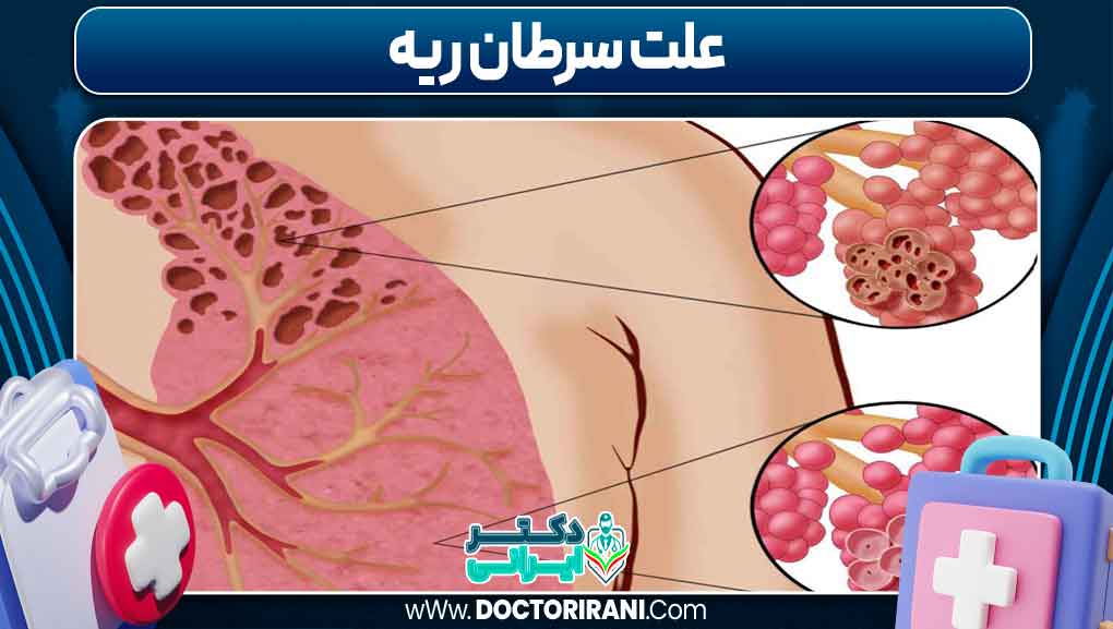 علت سرطان ریه