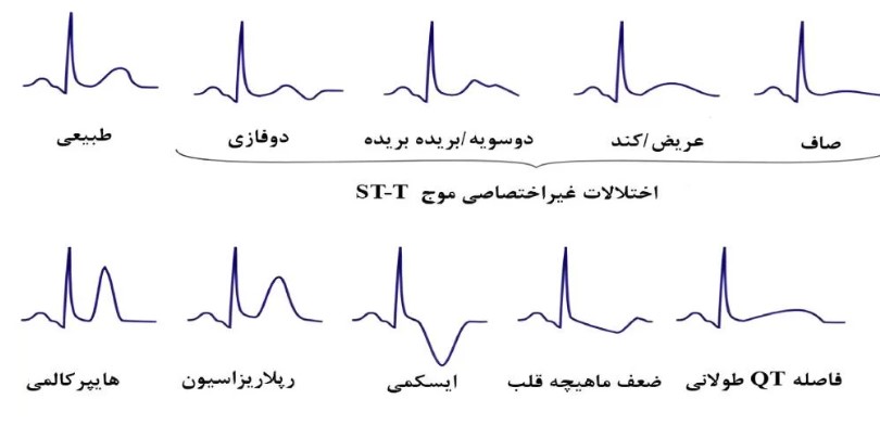 نحوه تفسیر نوار قلب