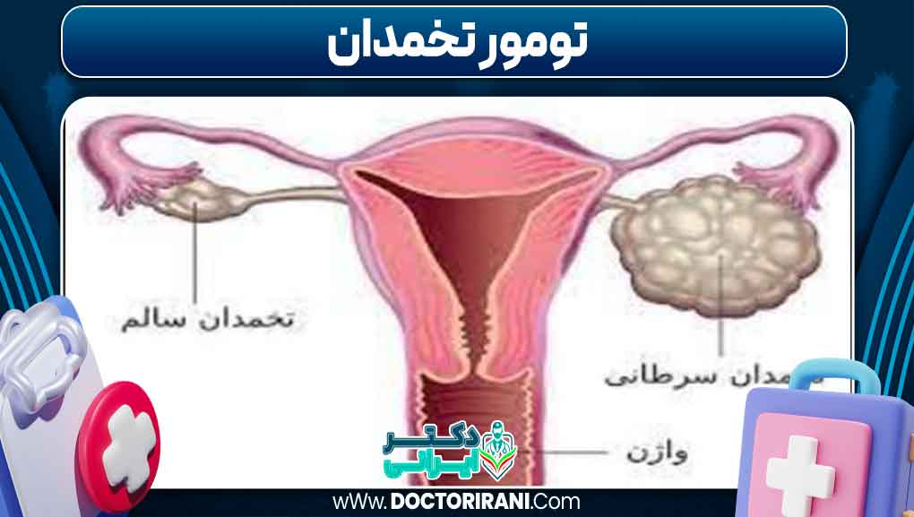 تومور تخمدان