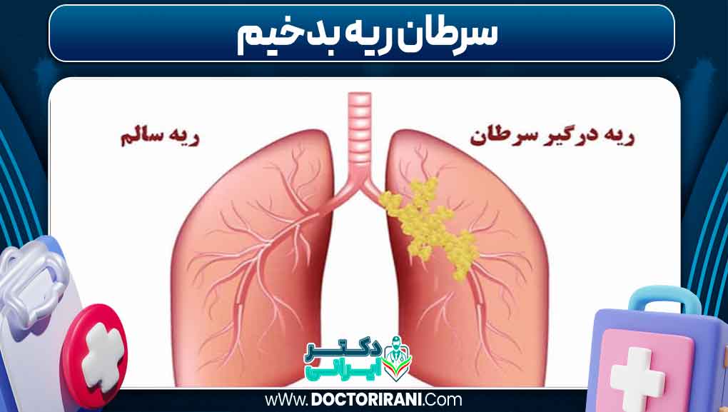 سرطان ریه بدخیم