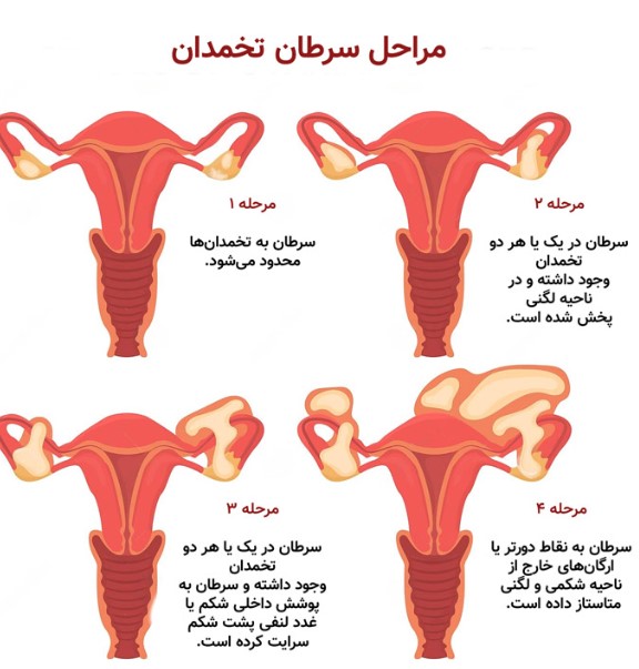 آیا سرطان تخمدان قابل درمان است