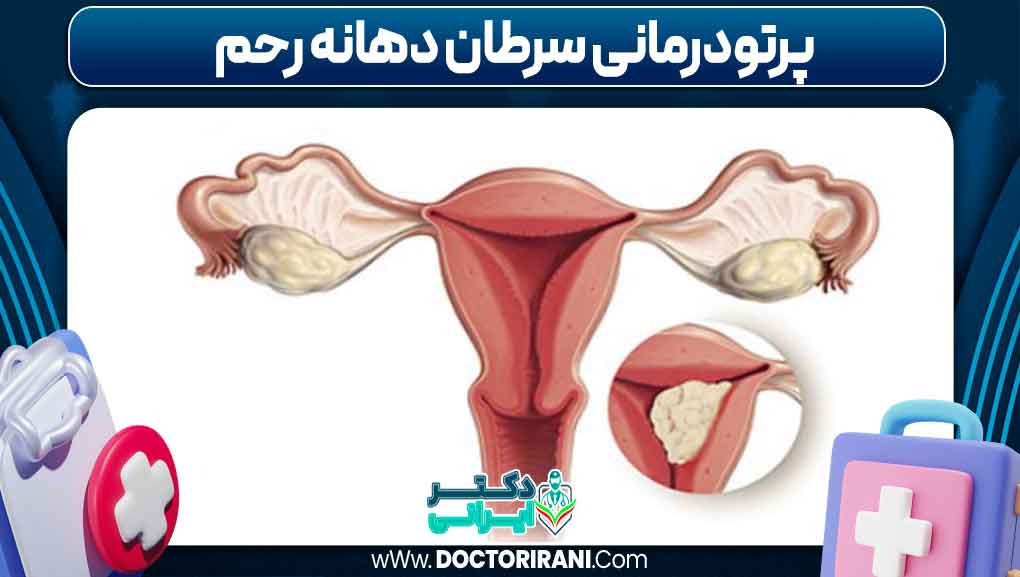 پرتودرمانی سرطان دهانه رحم