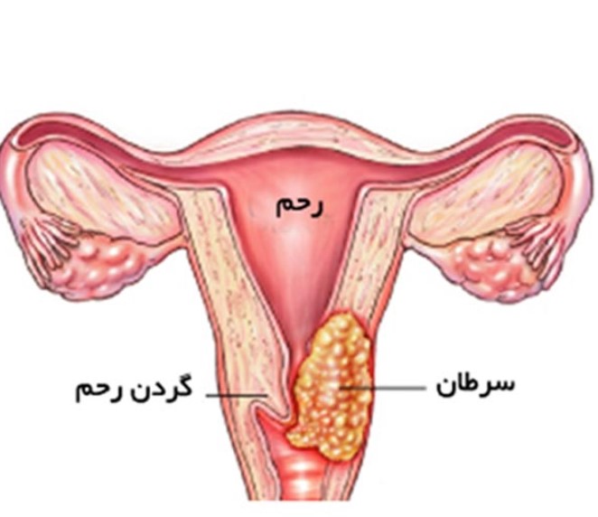 سرطان اندومتر و دیابت
