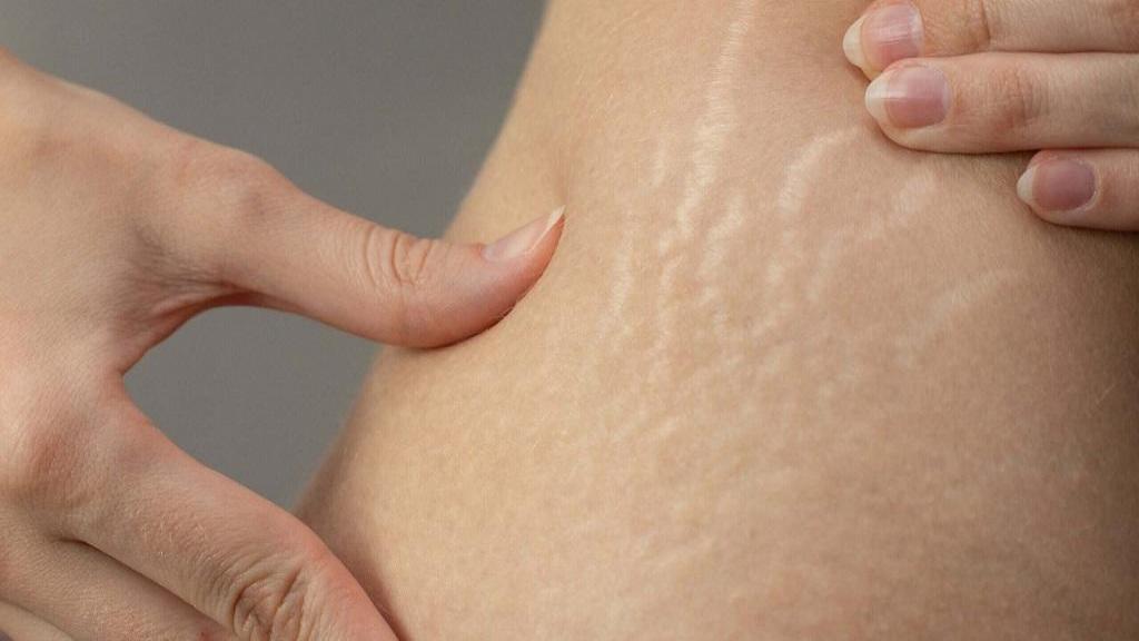 مشکلات پوستی ناشی از رژیم چاقی فوری