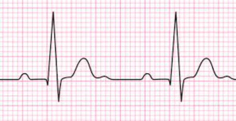 امواج P در نوار قلب