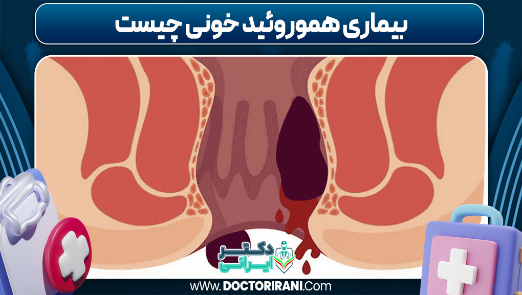 بیماری هموروئید خونی چیست بیماری هموروئید خونی چیست