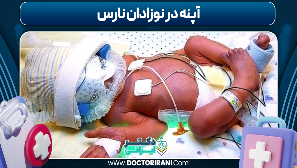 آپنه در نوزادان نارس