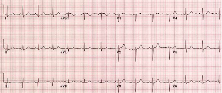 ریتم طبیعی قلب در نوار قلب