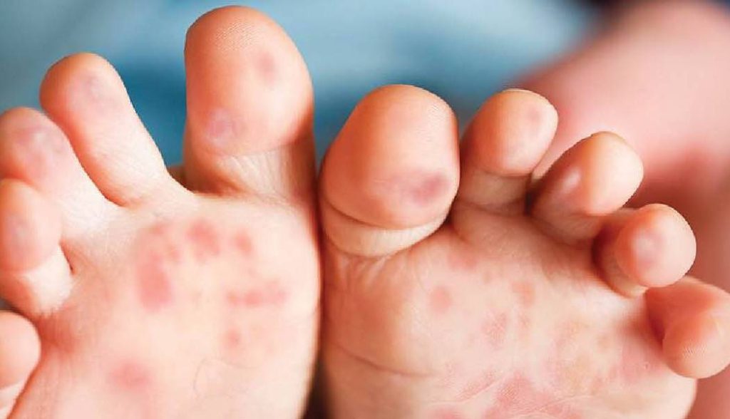راه درمان بیماری دست پا دهان در کودکان