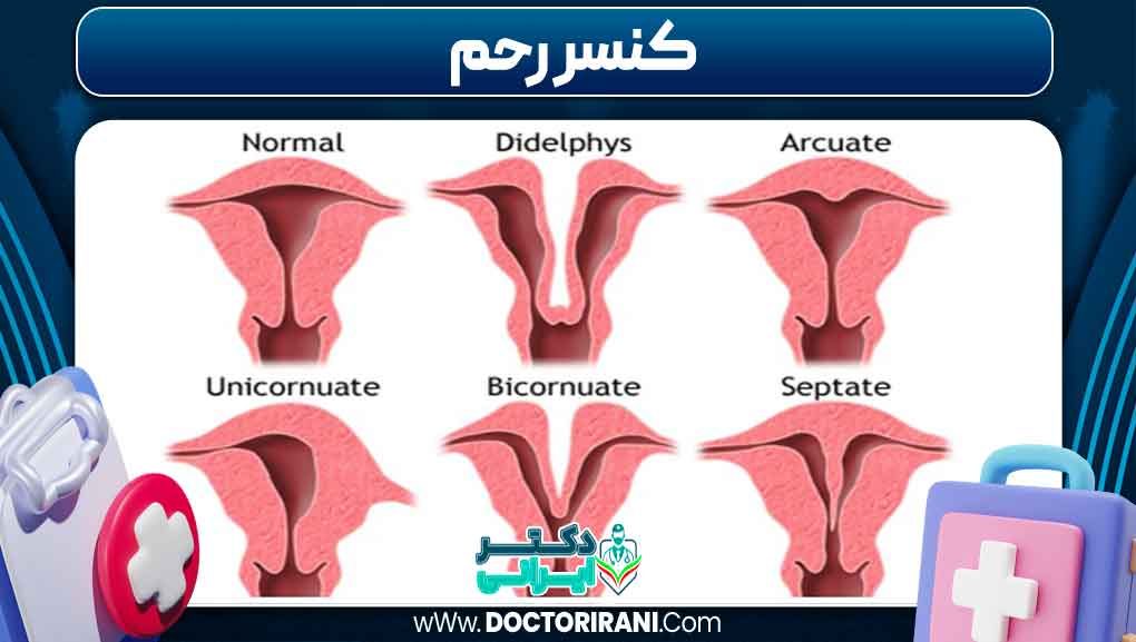 کنسر رحم