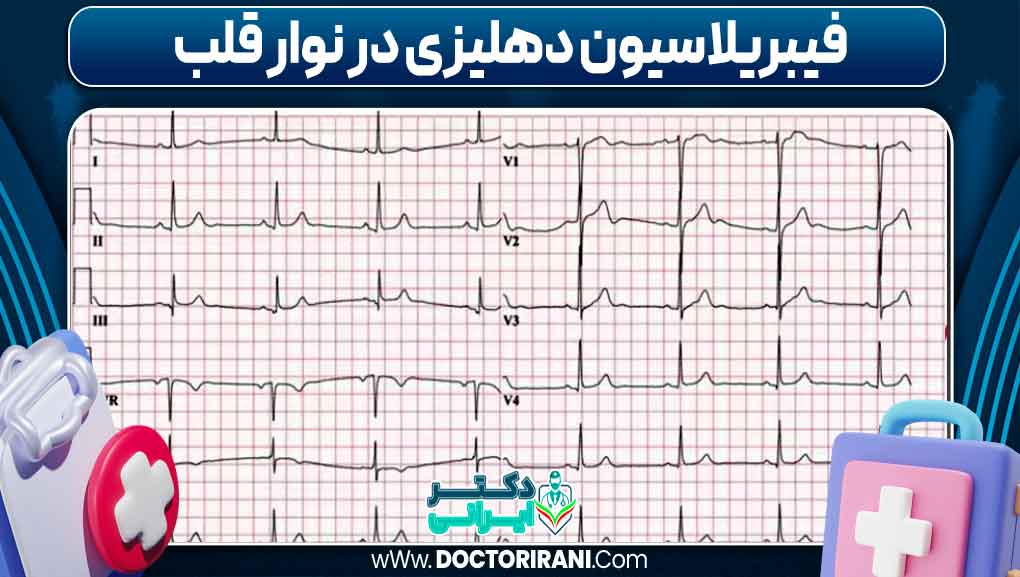 فیبریلاسیون دهلیزی در نوار قلب