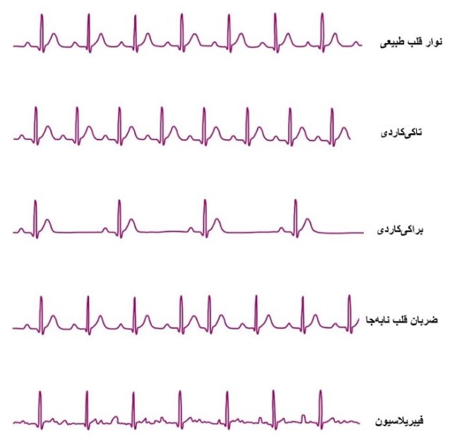 تاکی کاردی بطنی در نوار قلب