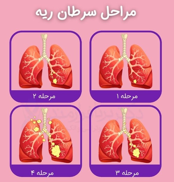 تومور ریه قابل درمان است