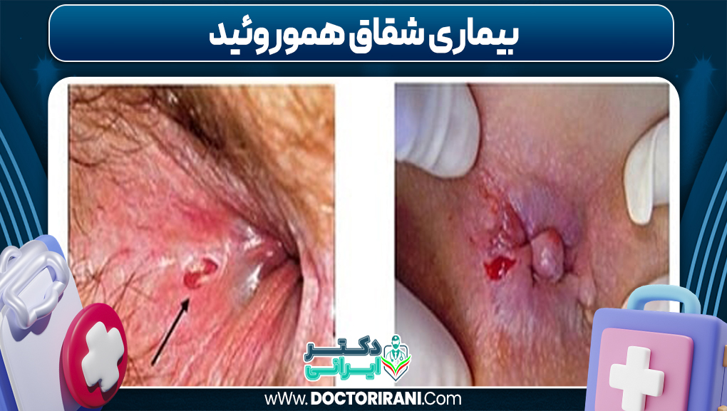 بیماری شقاق هموروئید بیماری شقاق هموروئید