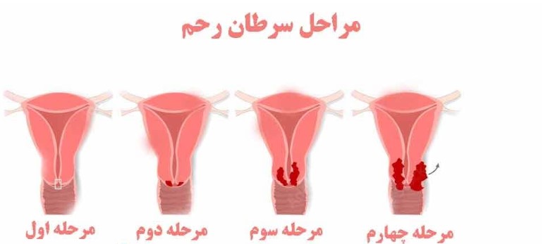 علائم سرطان رحم در بدن