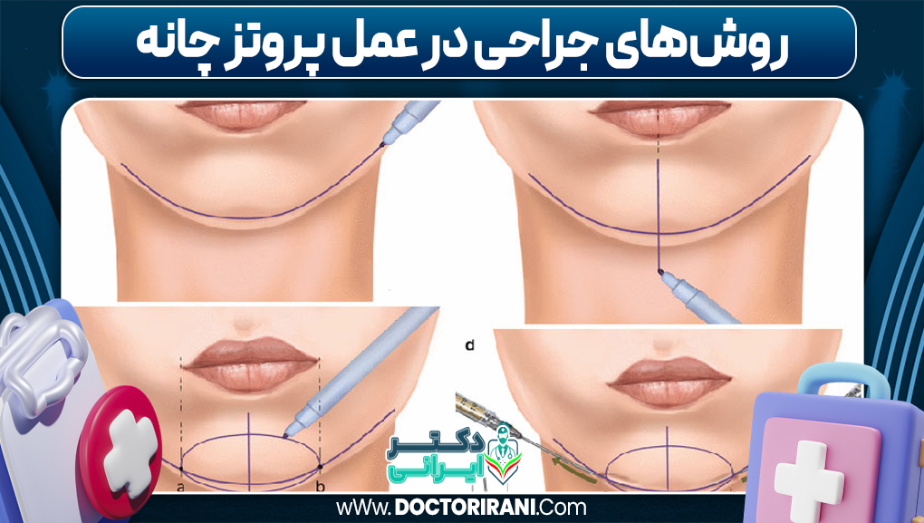 روش‌های جراحی در عمل پروتز چانه