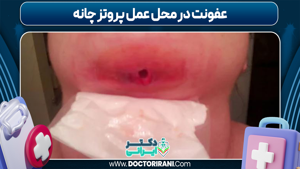 عفونت در محل عمل پروتز چانه
