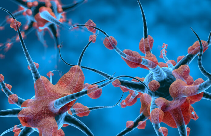 درمان بیماری نوروپاتی ارثی