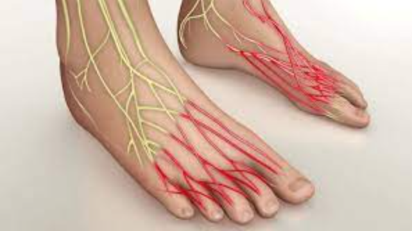 عکس بیماری نوروپاتی