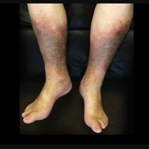 توصیه‌های سبک زندگی برای بیماران نارسایی مزمن وریدی