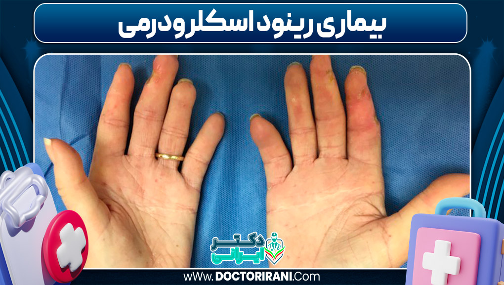 بیماری رینود اسکلرودرمی