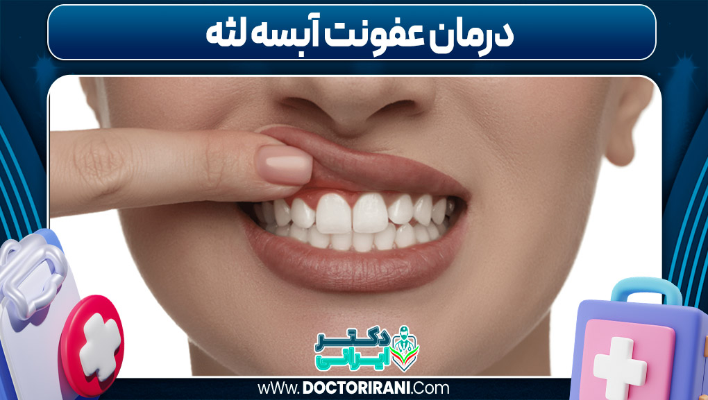 درمان عفونت آبسه لثه
